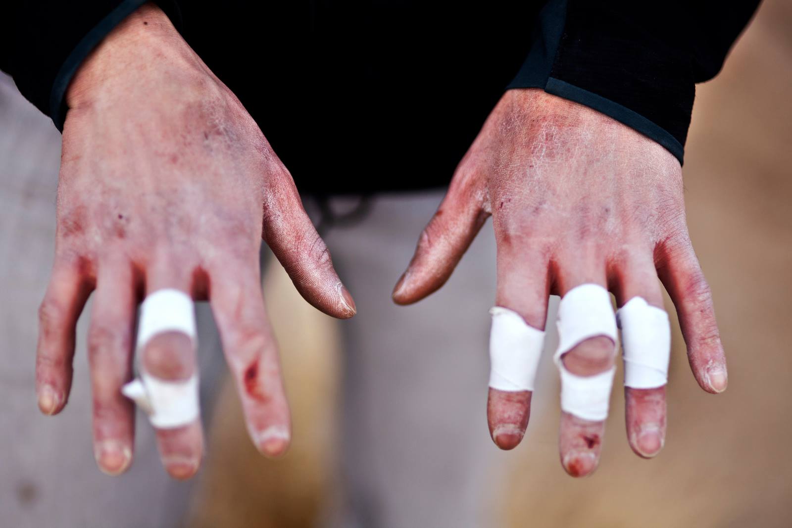 How to Care for Your Climbing Calluses (and prevent flappers)
